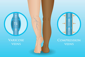 Do Leggings Help Varicose Veins?